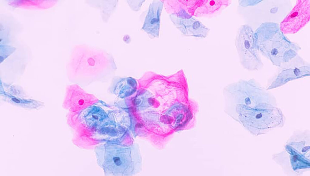 nieuwsbericht-hpv-shutterstock-2456146543